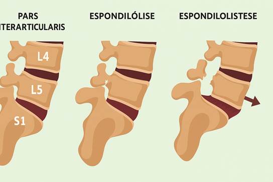 Espondilólise e espondilolistese lombar